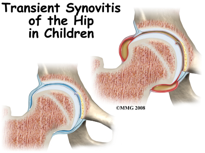 Guide for Transient Synovitis of the Hip in Children